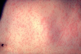 Morbillivirus_measles_infection.jpg
