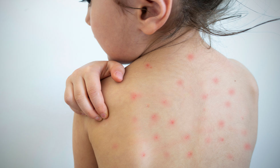 measles-su19 (1).jpg